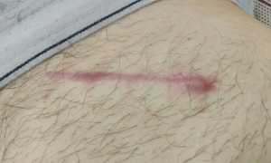 Осложнения острого аппендицита — дооперационные, интраоперационные и послеоперационные