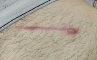 Осложнения острого аппендицита — дооперационные, интраоперационные и послеоперационные