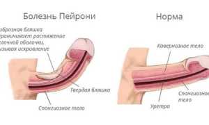 Массаж при болезни Пейрони — показания, способы и методы проведения, последствия