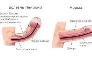 Массаж при болезни Пейрони — показания, способы и методы проведения, последствия