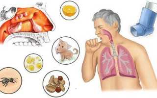 Аллергический синусит у детей и взрослых — симптомы и лечение