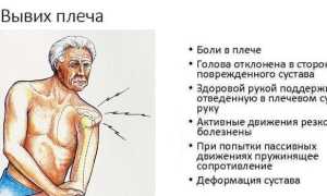 Что такое вывих — симптомы, первая помощь и лечение