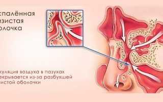 Катаральный гайморит у детей и взрослых — симптомы и лечение