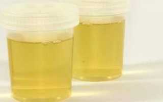 Ярко желтая моча у женщин, мужчин и детей: причины и как привести цвет в норму