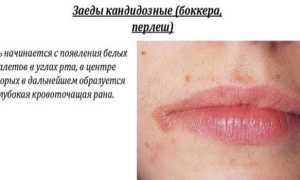 Заеды на губах — чем лечить у детей и взрослых