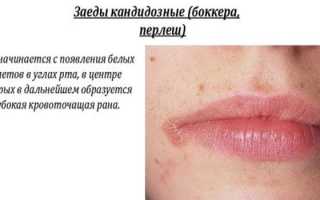 Заеды на губах — чем лечить у детей и взрослых