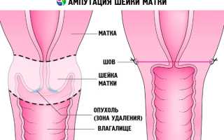 Возможна ли беременность после удаления шейки матки?