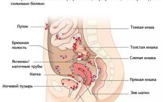 Как проявляется эндометриоз при климаксе, его симптомы и лечение?