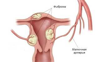 Фиброз матки: медикаментозные и хирургические методы лечения