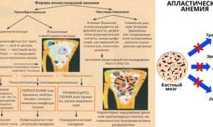 Апластическая анемия у детей и взрослых — симптомы и лечение