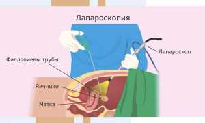 Трубный фактор: ЭКО или лапароскопия?