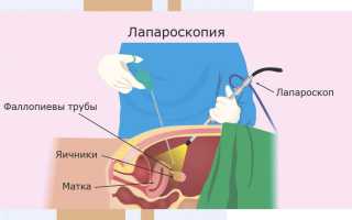 Трубный фактор: ЭКО или лапароскопия?