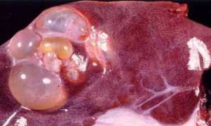 Эхинококкоз: симптомы, лечение