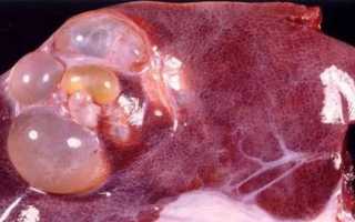 Эхинококкоз: симптомы, лечение