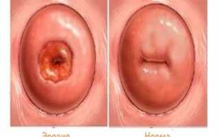 Всё, что нужно знать о декубитальной язве шейки матки