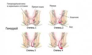 Геморроидэктомия открытая и закрытая — техники операции