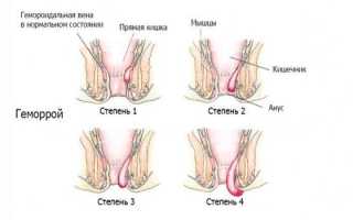 Геморроидэктомия открытая и закрытая — техники операции