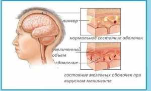 Цереброспинальный менингит: симптомы и лечение заболевания