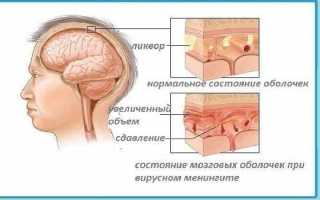 Цереброспинальный менингит: симптомы и лечение заболевания