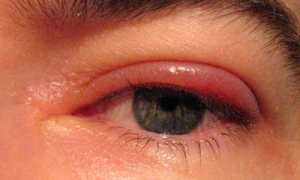 Если опухло верхнее веко