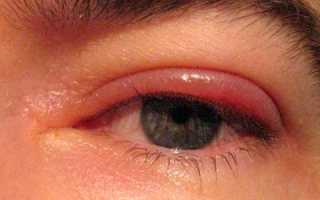 Если опухло верхнее веко