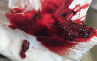 Какие симптомы выкидыша на ранних сроках беременности?