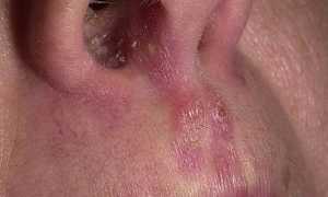 Грибок в носу у детей и взрослых