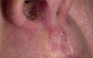 Грибок в носу у детей и взрослых