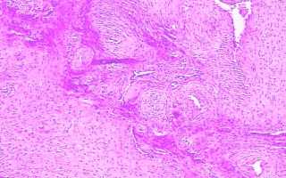 Причины появления ангиомиомы матки, клиническая картина, способы диагностики и терапии