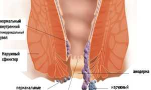 Лечение геморроя во время беременности