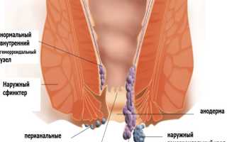 Лечение геморроя во время беременности
