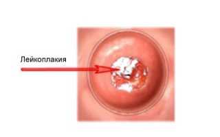 Как проводят радиоволновое лечение лейкоплакии шейки матки?