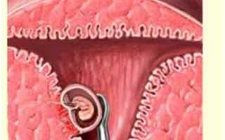 Выделения после выскабливания полости матки: норма и патология