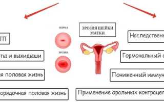 Эндоцервикоз шейки матки — признаки и как лечить