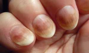 Средство от грибка ногтей на руках