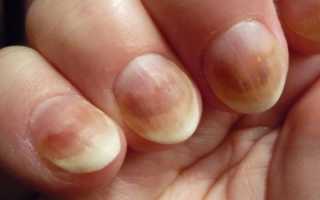 Средство от грибка ногтей на руках