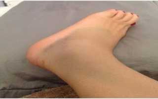 Как справиться с отеками во время овуляции?