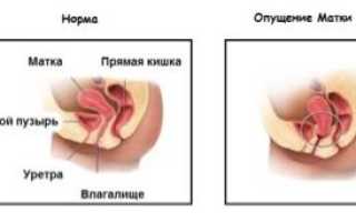 Как укрепить матку дома и в стационаре?