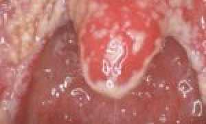 Опасность молочницы для организма