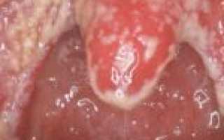 Опасность молочницы для организма