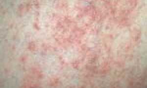 Тяжёлая форма хронического заболевания кожи — пустулёзный псориаз