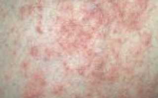 Тяжёлая форма хронического заболевания кожи — пустулёзный псориаз