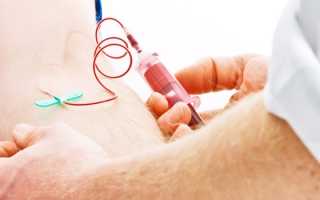 Аутогемотерапия – показания и противопоказания, механизм действия