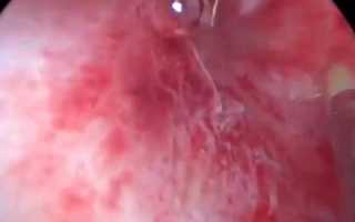 Симптомы гарднереллеза у женщин — как распознать начало болезни