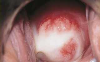 Кандидоз шейки матки: провоцирующие факторы и методы лечения