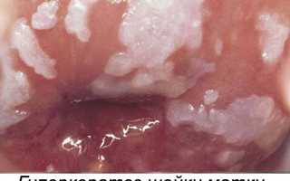 Что такое гиперкератоз шейки матки и как лечить это заболевание?