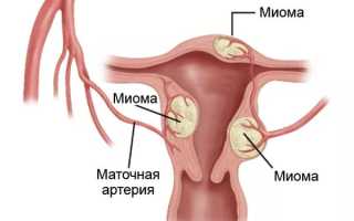 Профилактические мероприятия – панацея от страха развития миомы матки