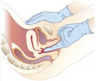 Гинекологический массаж