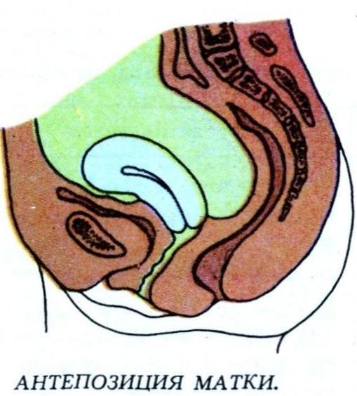 Антеверсия