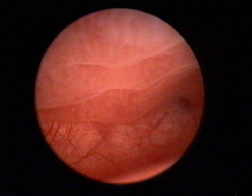 На гистероскопии